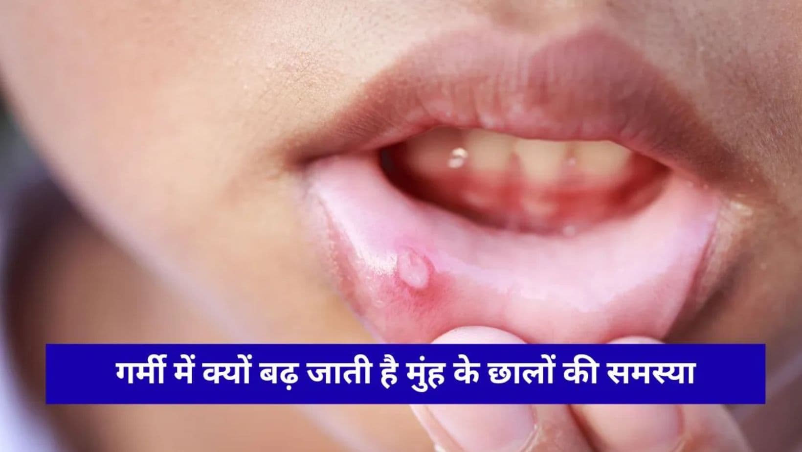 Mouth Ulcers Alert : गर्मी के मौसम में मुंह के छाले दे रहे हैं दर्द, आयुर्वेद और डॉक्टरों ने बताए असरदार उपाय